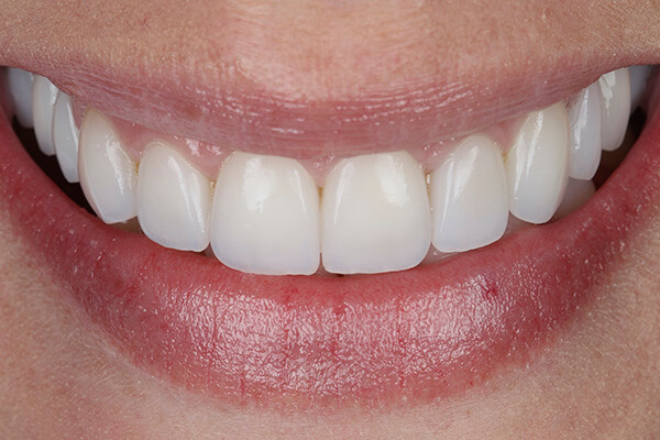 Leia mais sobre o artigo Antes e Depois de Lentes de Contato Dental em Porcelana