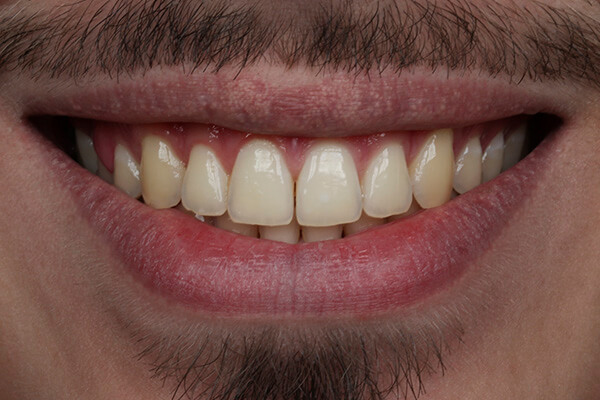 antes clareamento dental