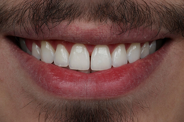 Leia mais sobre o artigo Especialista em Clareamento Dental em Chapecó