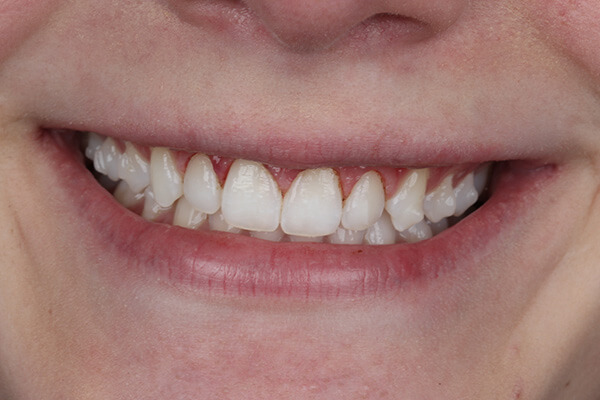 g\correção gengival