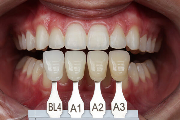 Leia mais sobre o artigo Escolha da cor das Lentes de Contato Dental