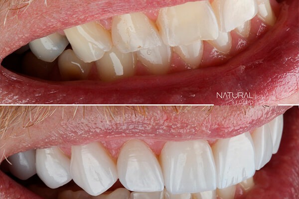 Leia mais sobre o artigo Esmalte do Dente: por que é importante conservá-lo?