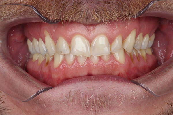 desgaste dental antes