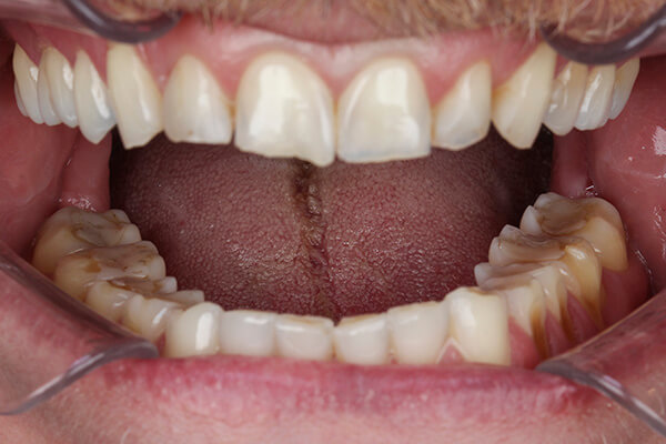 Leia mais sobre o artigo Você sofre de Bruxismo?