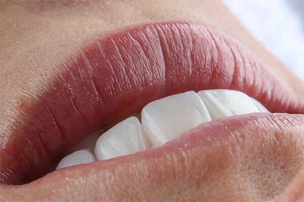 Leia mais sobre o artigo Mitos e Verdades sobre o Clareamento Dental!