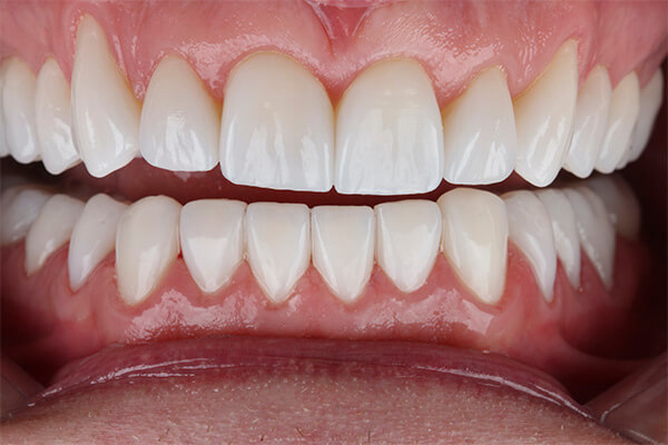 desgaste dental depois