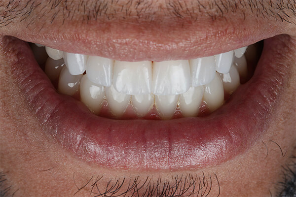 Leia mais sobre o artigo Preciso fazer Desgaste nos Dentes para colocar Lentes de Contato Dental?