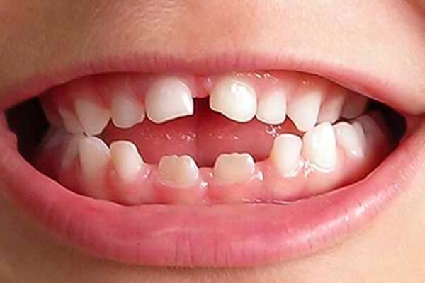 uso prolongado da chupeta