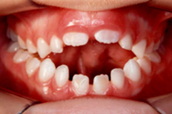 uso prolongado da chupeta