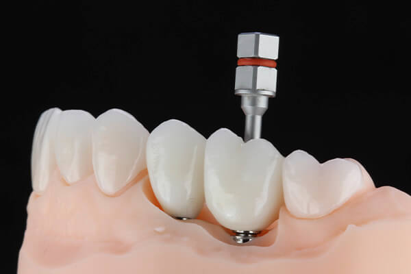 Leia mais sobre o artigo Prótese Sobre Implante: O que é e quando é utilizada?